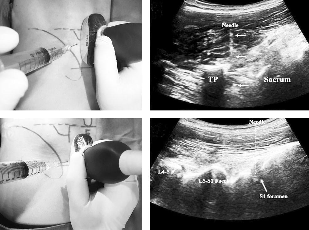 Kwang Pyo Ko et al Volume 25 Number 4 December 31 2018 A C Fig. 8. L5-S1 selective nerve root block. (A) A gross image of L5 nerve root block is shown. (B) The L5 nerve root block approach is shown.