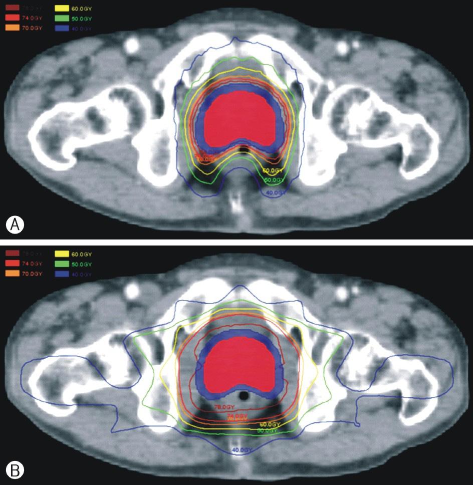 기용간외 : 노인전립선암환자에서토모테라피의적용 Table 4.