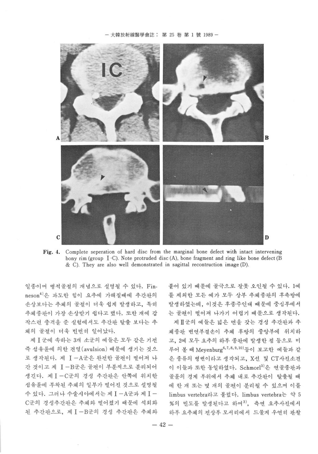 大韓放射線뿔學會註 : 第 25 卷第 1 號 1989 - B D F ig. 4. Complete seperation of hard dìsc from the marginal bone defect wi th intact intervening bony rim (group 1.C).