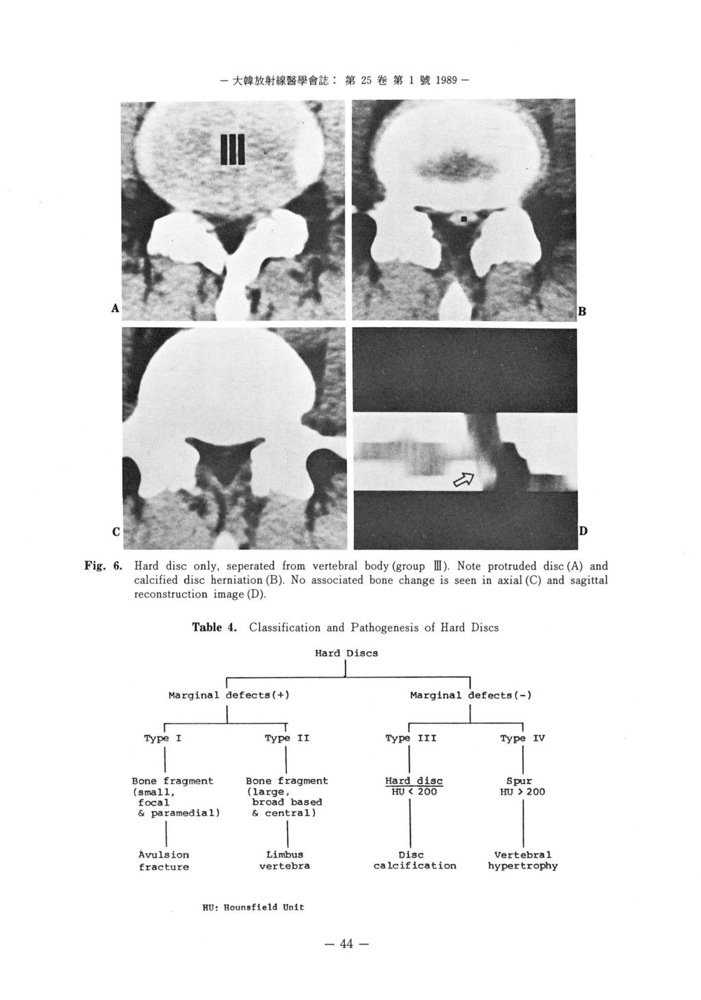 - 大韓放射線醫學會誌 : 第 25 卷第 1 號 1989 - A C Fig. 6. Hard disc only, seperated from vertebral body (group ill ). Note protruded disc (A) and calcified disc herniation (B).