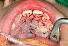 After elevation of palatal flap, the cyst was completely