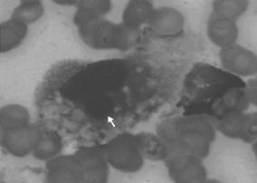 - 윤현정외 4 인 : 전신성홍반성루푸스에서혈구탐식증후군 - Figure 2. Bone marrow aspiration shows hemophagocytosis of hematopietic cell by histiocyte (Wright & Giemsa stain, original magnification 1,000).