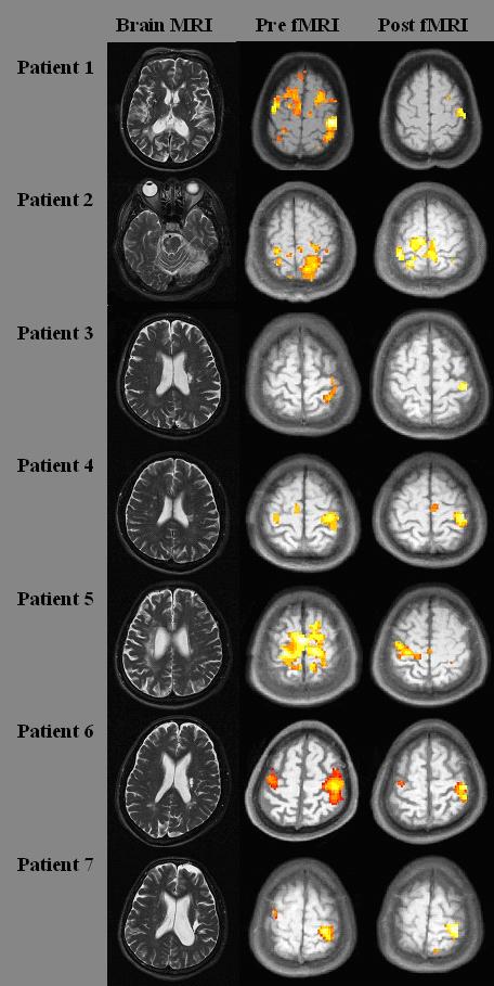 - 36 - Figure 11. fmri findings. Ipsilateral primary sensorimotor cortex (SMC) activity disappeared in 4 patients (patient 1,2,4,5) or decreased in 1 patient (patient 6).