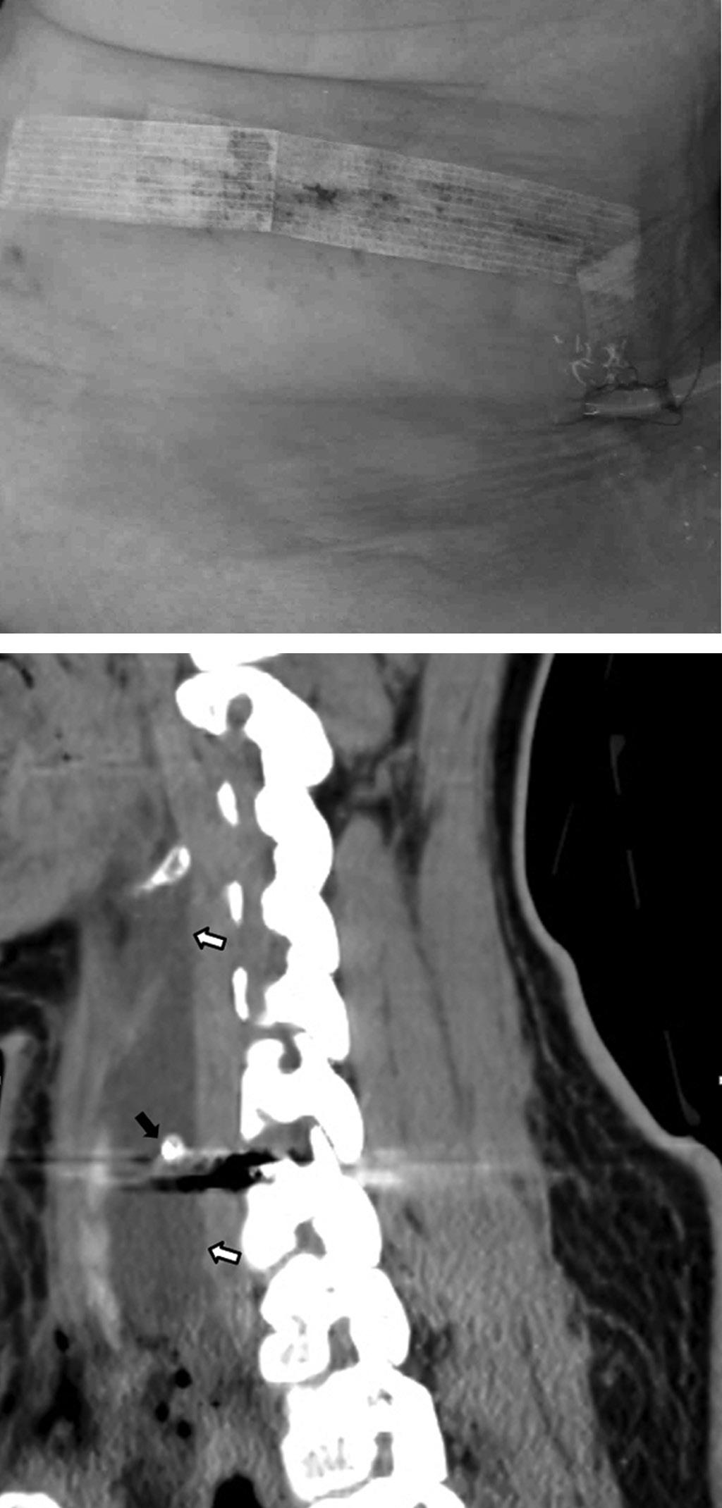 A preoperative magnetic resonance image showed C5-6 foraminal stenosis and C6-7 herniated nucleus pulposus. A B Fig. 2.
