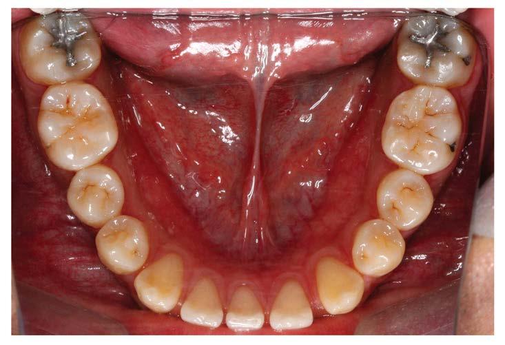 고유구강 - 치아활안쪽공간