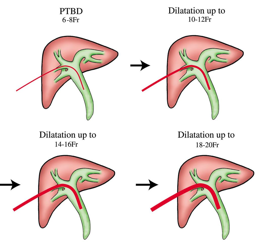 Fig. 6. Position of patient with right PTBD. Fig. 4. Multi stage tract dilation. Fig. 7. Position of patient with left PTBD. Fig. 5. One stage tract dilation.