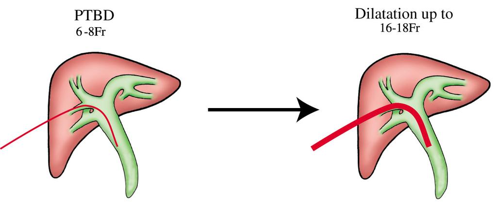 그러므로확장된 PTBD 통로가카테터를제거한이후에도안정적으로유지되어 PTCS 시술이용이하게이루어지려면통로확장후에적어도 7 10일정도안정화하는기간이필요하다.