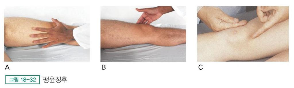 슬관절 무릎의부종이생기면관절에액체가증가되어서인지연조직의부종때문인지감별하기위해서슬개골의팽윤징후 (bulge sign) 와부구감 (ballottement) 검사실시 팽윤징후 (Bulge