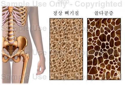 노인기고려사항 골다공증 (osteoporosis) 나이가들면서뼈기질의상실 ( 재흡수 ) 이새로운뼈의성장 ( 축적 ) 보다더빠르게발생여성 > 남성, 백인 > 흑인척추의축소 : 체위변화는노화의증거, 키의감소예 ) 척추후만증