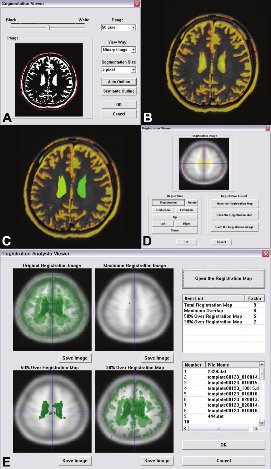 뇌 MRI 를대리결론변수로하는임상시험을위한병변의뇌표준판등록및정량분석소프트웨어개발 : 예비보고 은영상자료에대해 3개월간격을두고반복하여정합작업을수행하였다. 신경해부학적지식과기존의연구결과 10,11 를바탕으로다음과같은선험적전제 (a priori premises) 및가설하에영상분석을시작하였다.