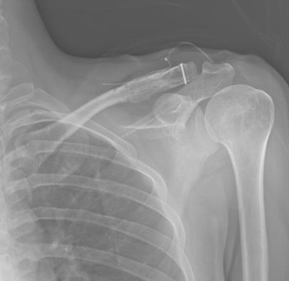 (A)Preoperative clavicle anteroposterior view presents fracture