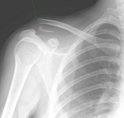 (B)She was treated by additional tension band wiring because of comminution. (C)Roentgenogram after removal of wires at postoperative 15 months.