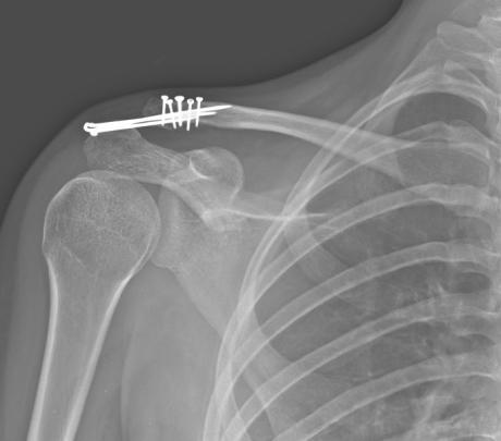 Intraarticular transacromial K-wire fixation was used to treat a 21-year-old female with right distal clavicle fracture(craig type V) and acromioclavicular