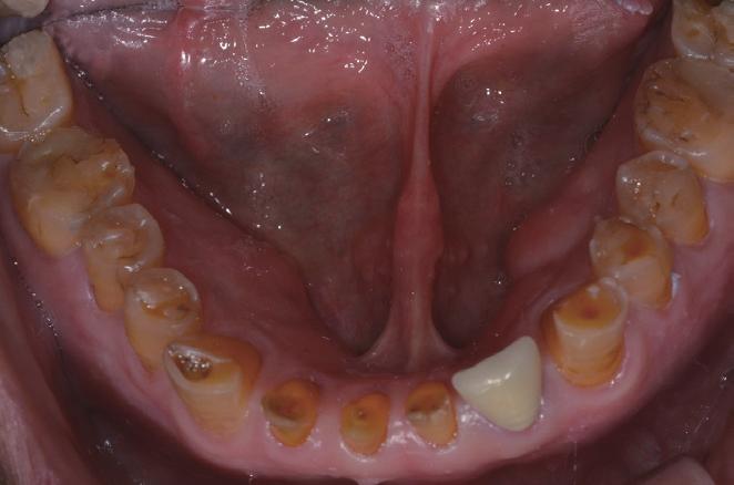 말단비대증 환자의 악안면 영역의 증상으 로는 혀와 입술의 비대 및 수면 무호흡증을 일으킬 수 있 본 증례는 59세 남자 환자로서 전반적인 치아의 마모 는 구개음 조직(palatal