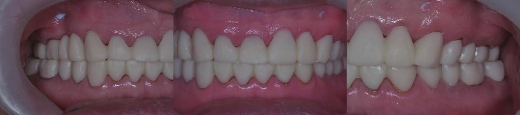 Full mouth rehabilitation on the patient with severe tooth wear and tooth fracture using reestabilishment of occlusal vertical dimension Fig. 5. 1st provisional restoration.