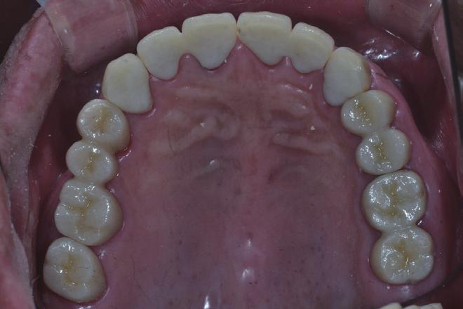 2개월의 임시합착기간 동안 모든 치아 치를 제작하여 보철물 파절이 발생하지 않도록 하였다.