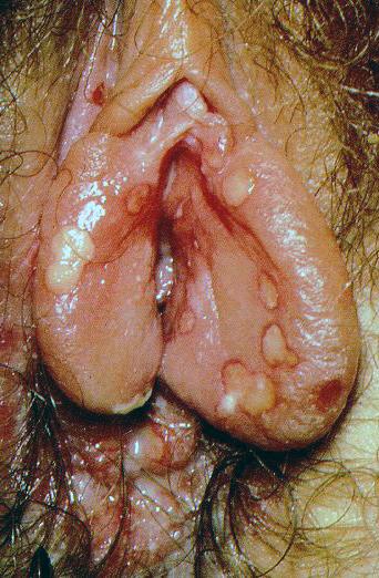 성기단순포진 (Genital Herpes) 병인 Herpes simplex virus (HSV) 2 형, 1 형 임상소견 임상사진 원발성 (primary) 광범위한통증성수포및궤양성성기병변 (