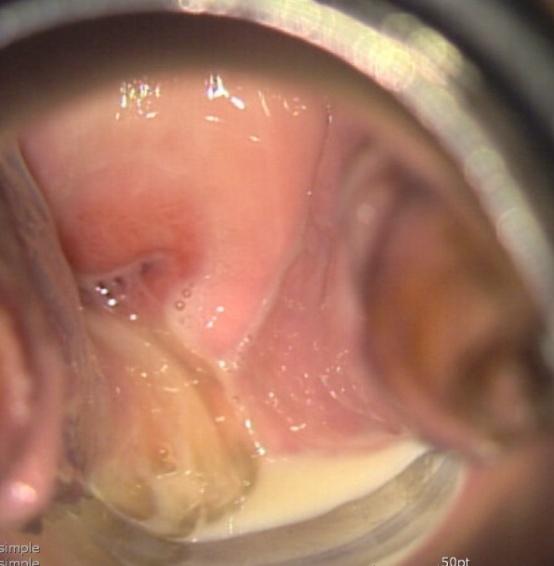 질염 (Vaginitis) 병인 증상및 징후 세균성질염 (bacterial vaginosis), 칸디다질염 (candidiasis), 트리코모나스질염 (Trichomoniasis) 임상소견임상사진 원인균