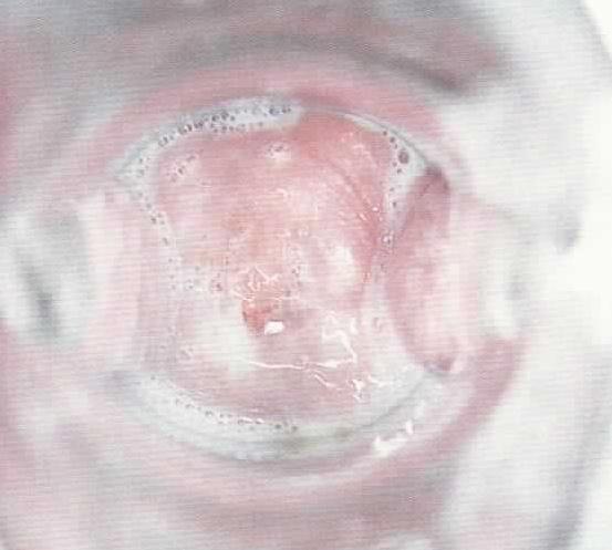 glabrata, Saccharomyces cerevisiae 잠복기 : 2-3 주 (6 주까지 ) 무증상 : 20% 질분비물호소칸디다질염 외음부의가려움증 (candidiasis) 배뇨통, 성교통
