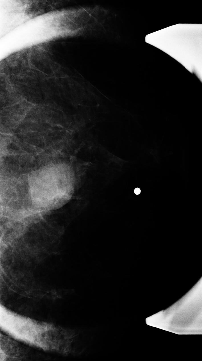 probable benign lesion. It was confirmed as a borderline phyllodes tumor in 33-year-old woman. Fig. 2.