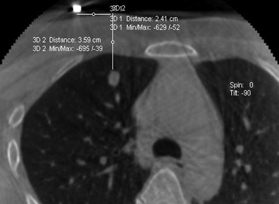 A B C D Fig. 1. A small pulmonary nodule in the right upper lobe of a 47-year-old woman with history of breast cancer. A. About 1 cm-sized well-marginated, small, round nodule in RUL is noted on the lung setting axial image of the HRCT.