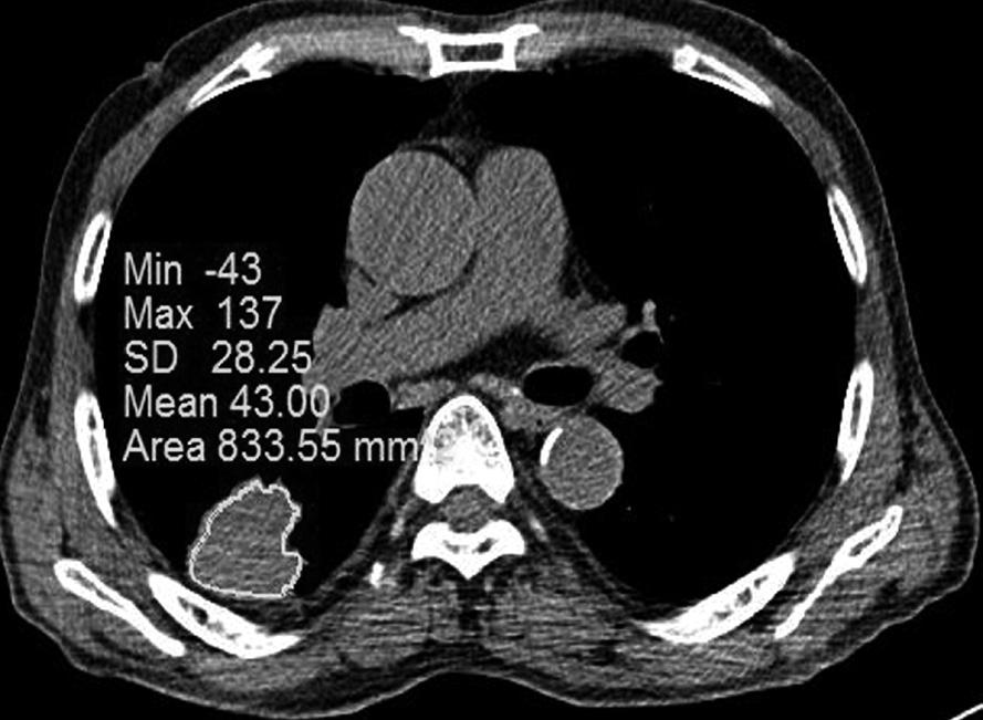 모든환자는 CBCT (Syngo DynaCT, Siemens AG, Healthcare Sector, Forchheim, Germany) 기능을가지고있는투시조영장치 (AXIOM Artis dba; Siemens Medical Solutions, Forchheim, Germany) 를사용하였다.