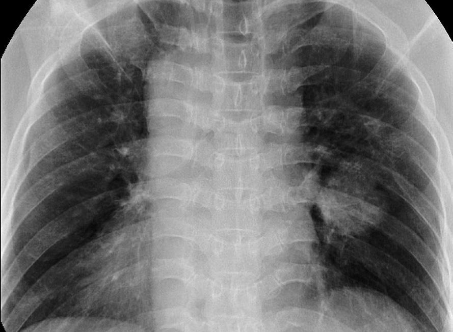 A solitary pulmonary mass suspicious for malignancy in the right lower lobe of a 72-year-old man, which was well-marginated, irregularshaped, and abutting the pleura. A.