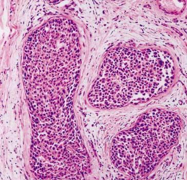 326 장은덕 이안희 이은정외 2 인 Fig. 4. Group 3 cases () HE section shows small neoplastic cells in a solid growth pattern of ductal carcinoma in situ. () Corresponding E-cadherin immunostain shows positive.