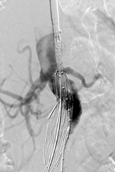 (A) Before deployment of Zenith endograft.