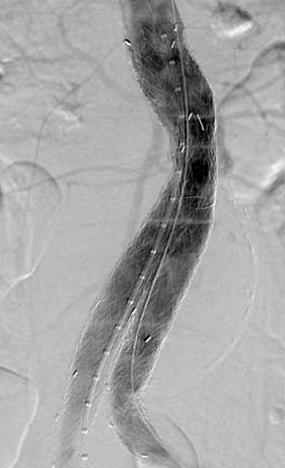 Completion angiogram shows control of type I endoleak.