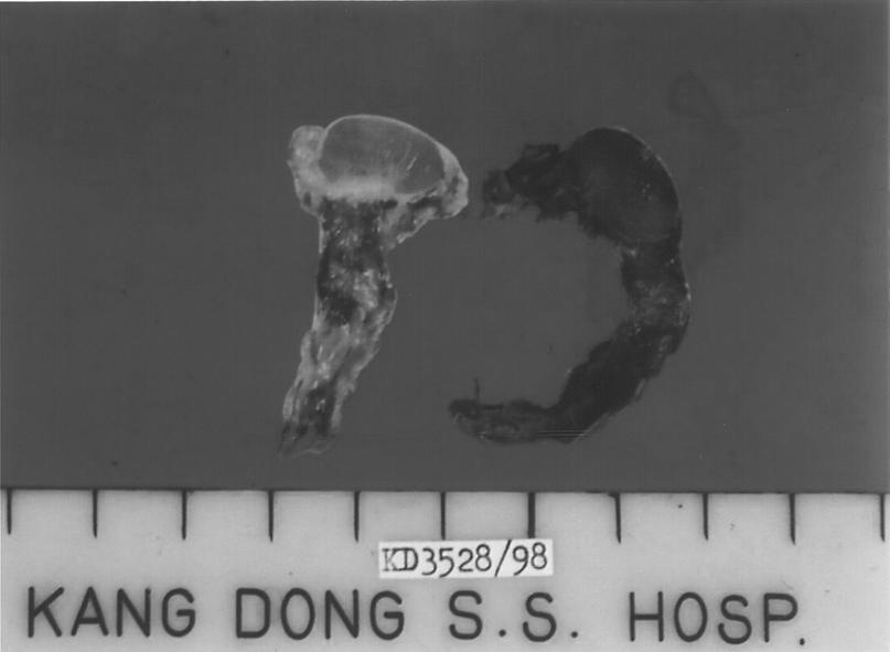 5x1x1cm with yellowish-brown granular cut surface and attached spermatic cord. 환자의 외부 생식기는 정상 여성의 형태 miu/ml)은 0.22 miu/ml 였다.