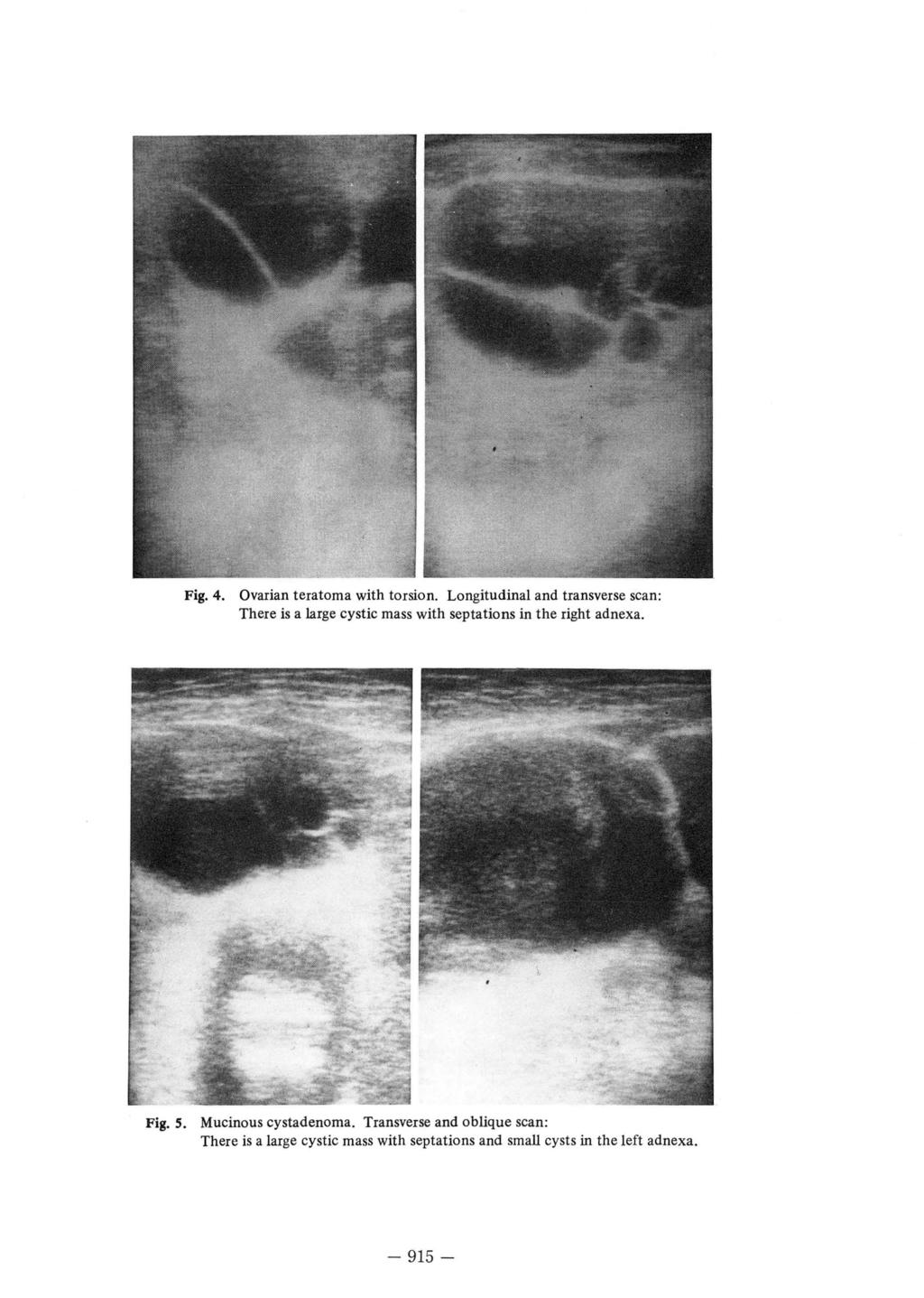 Fig. 4. Ovarian teratoma with torsion. Longitudinal and transverse scan: There is a large cystic mass with septations in the right adnexa. Fig.