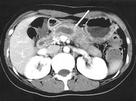 (B) Post-enhancement CT scan shows dilatation of the main pancreatic duct (arrow). igure 2. 99mTc-IBI scan.