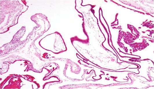 Bo-Ra Park, et al. Laparoscopic treatment of the retroperitoneal ectopic pregnancy Fig. 3. The pathologic fi ndings showed trophoblastic villi adherent to the retroperitoneum (H&E, 100).