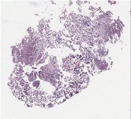 - Woo Jae Kim, et al. case of successful posaconazole salvage therapy for rhinocerebral mucormycosis - C Figure 3.