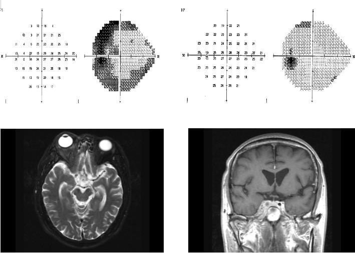 Follow up brain MRI shows an aggravated state of retrobulbar, periorbital inflammation, () and enhancement of the cerebral peduncle meninges ().