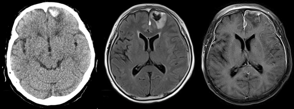 A B C Figure 1. Initial Brain CT and MRI performed one day after symptom onset. (A) A 1.5 cm-sized hematoma with perilesional edema was seen in the left frontal cortex. (B) A 1.