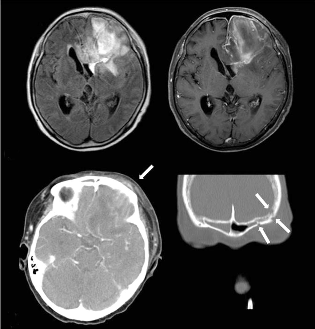 And diffuse pachymeningeal enhancement along both, worse on the left, frontal lobe was seen on T1-enhanced imaging. A B C Figure 2. (A) Follow-up MRI performed three weeks after symptom onset.