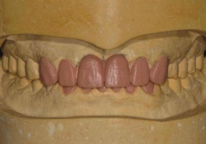 () Full contour wax-up, () Surgical template, () Provisional  면을