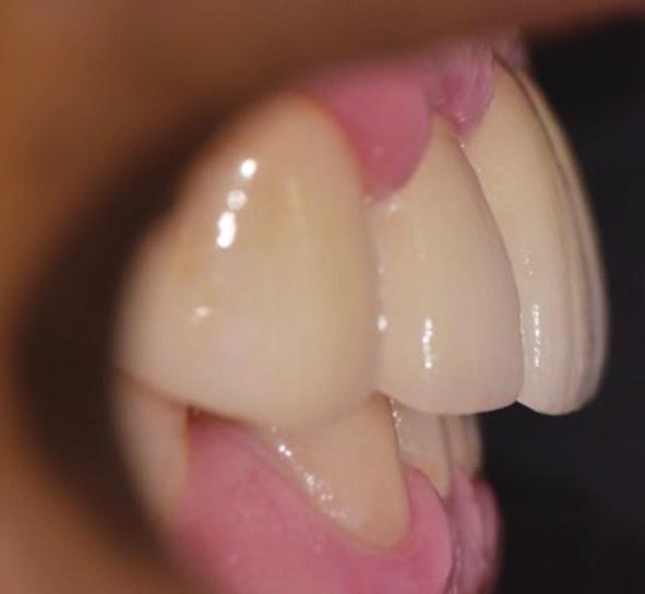 16). 교합 시 모든 치아가 균등하게 접촉하며 기능 운동 시에는 후방 교합 46 접촉의 즉각적인 이개를 동반하는 전방 유도를 회복하여 구치부 를 과도한 마모로부터 보호하도록 하였다.