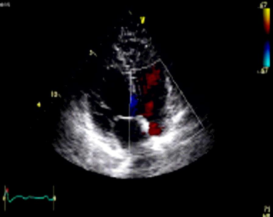 - Hye-Sun Seo, et al. Diagnosis and assessment of pulmonary arterial hypertension - Figure 1. The echocardiographic measurement of peak pulmonary artery pressure (PAP).