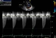 Therefore, estimated PAP is about 25mmHg after added 5mmHg of RA pressure. 니기때문에진단이수개월에서수년까지미뤄지는경우가많다. 따라서진단될당시에는병이상당히진행된상태일수있다. 폐동맥고혈압진단을어렵게하는또한가지의이유는다른모든가능한진단들을제외한후에야진단이가능하기때문에진단을내리기가쉽지않다는것이다.