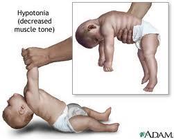 floppy baby 근육긴장저하유아증후군 (floppy baby syndrome) 15 2) 상염색체열성근이영양증 (Autosomal Recessive Muscular Dystrophy) 사지대형