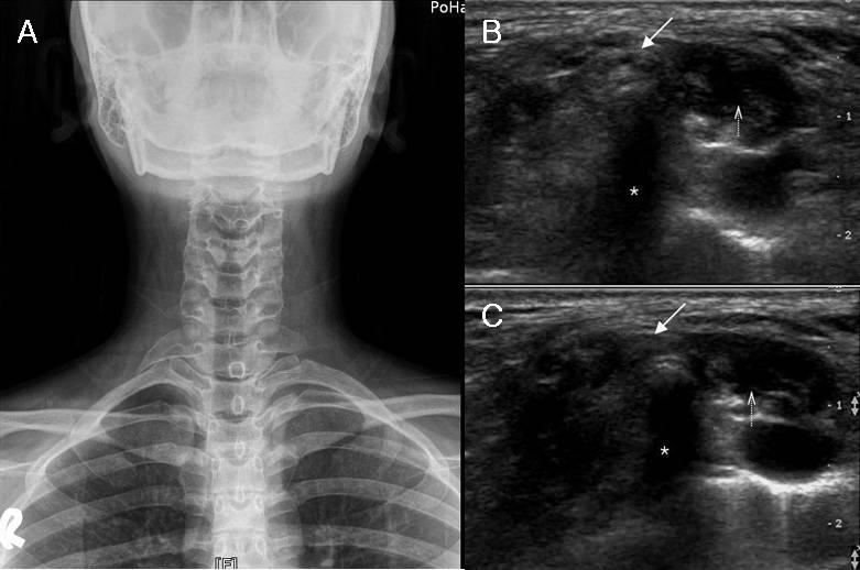 Figure 2. (A) Bilateral cervical ribs were found in Chest X-ray. Right side is more prominent. (B) Ultrasonographic findings in neutral position.