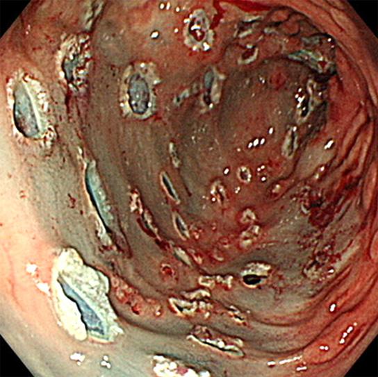 Various sized multiple polyps were noted in the ileal pouch in a patient with familial adenomatous polyposis (FAP) after Koch s pouch continent ileostomy. The largest one was 15 mm in diameter.