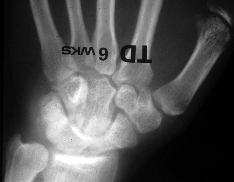 (C) Radiographs of the thumb carpometacarpal joints at 6 months.