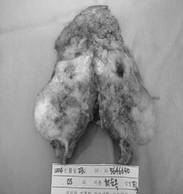 고찰 Figure 4. Plain radiograph demonstrates a huge soft tissue mass with indis tinctive margin and scattered punctuated calcification within the mass in left pelvic area. 측상완골병변은조직검사상내연골종및골연골종으로진단되었다.