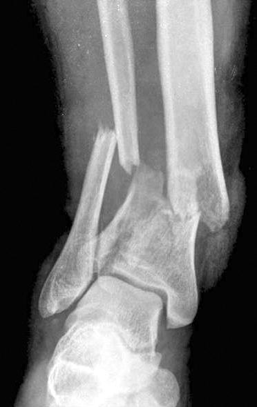 46 손욱진, 김대성 Fig. 3. (A) A 38 year old man sustained an intraarticular fracture of right distal tibia (AO/O type 43, C1) after traffic accident. (B) Medial open wound was showed.
