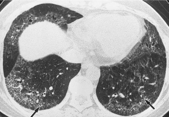 ILD in CVD Figure 11. Mixed connective tissue disease and usual interstitial pneumonia.
