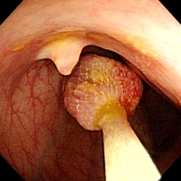The resected polyp is composed of the hyperplastic mucosa and the branches of smooth muscle which separates mucosal elements into lobules (H&E stain, 40). 하여 용종절제술을 시행하였다(Fig. 2A).